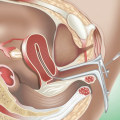 Everything You Need to Know About Intrauterine Insemination (IUI)