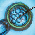 Multiple Births from ART Treatments: A Comprehensive Overview