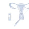 Egg Donation Cycle Timeline