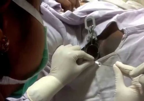 Understanding Embryo Transfer in IVF