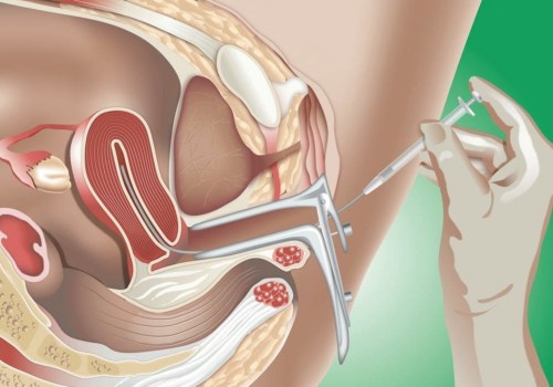 Everything You Need to Know About Intrauterine Insemination (IUI)